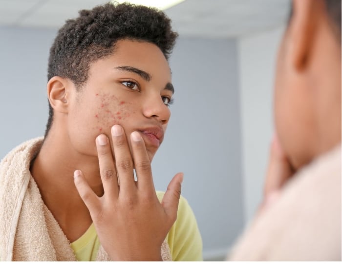 Exploring Acne Treatment Options: At Your Pharmacy
